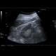 Renal carcinoma, small, detected on ultrasound, correlation of ultrasound and CT: US - Ultrasound